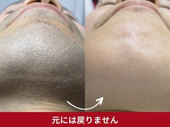 美容脱毛専門サロン エピラージュ 新宿店(Epilage)/青ヒゲも元には戻りません！