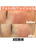 【シミ、くすみ改善】光フェイシャル50分　¥9800→¥5500