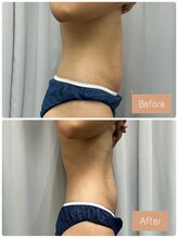 FJ/お腹周りのセル脂肪ケア！痩身
